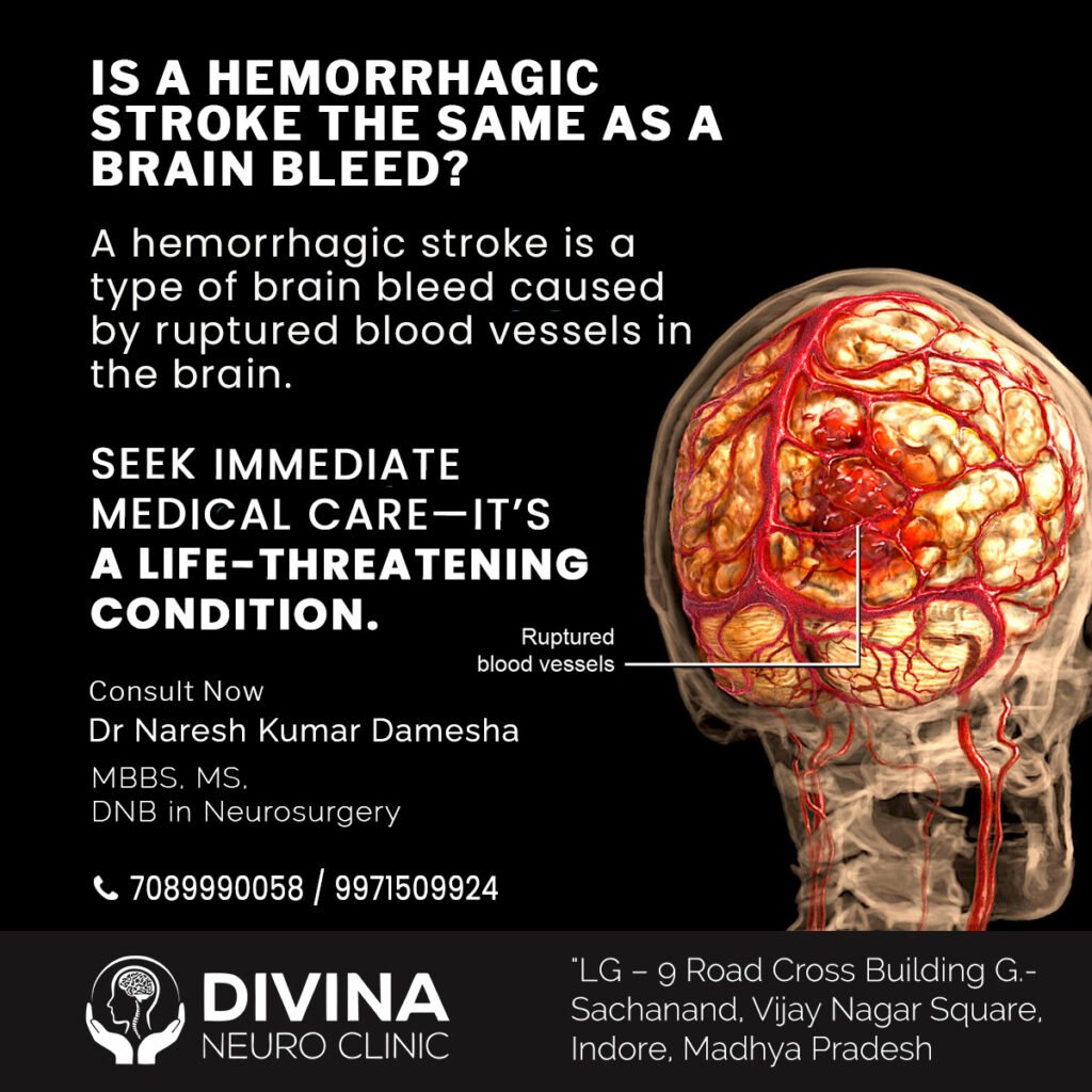 Is a Hemorrhagic Stroke the Same as a Brain Bleed? 