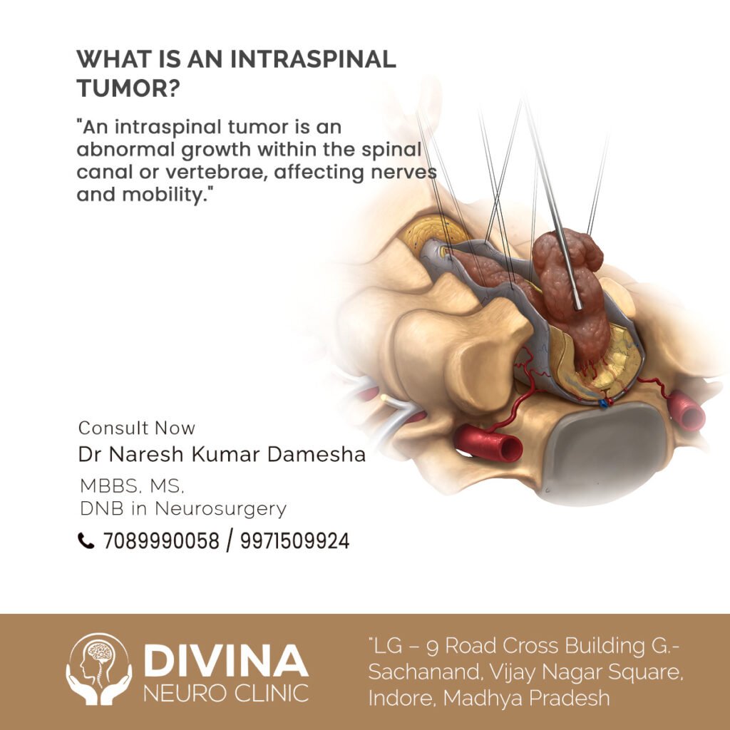 What is an Intraspinal Tumor?, Symptoms, Causes, Treatment   